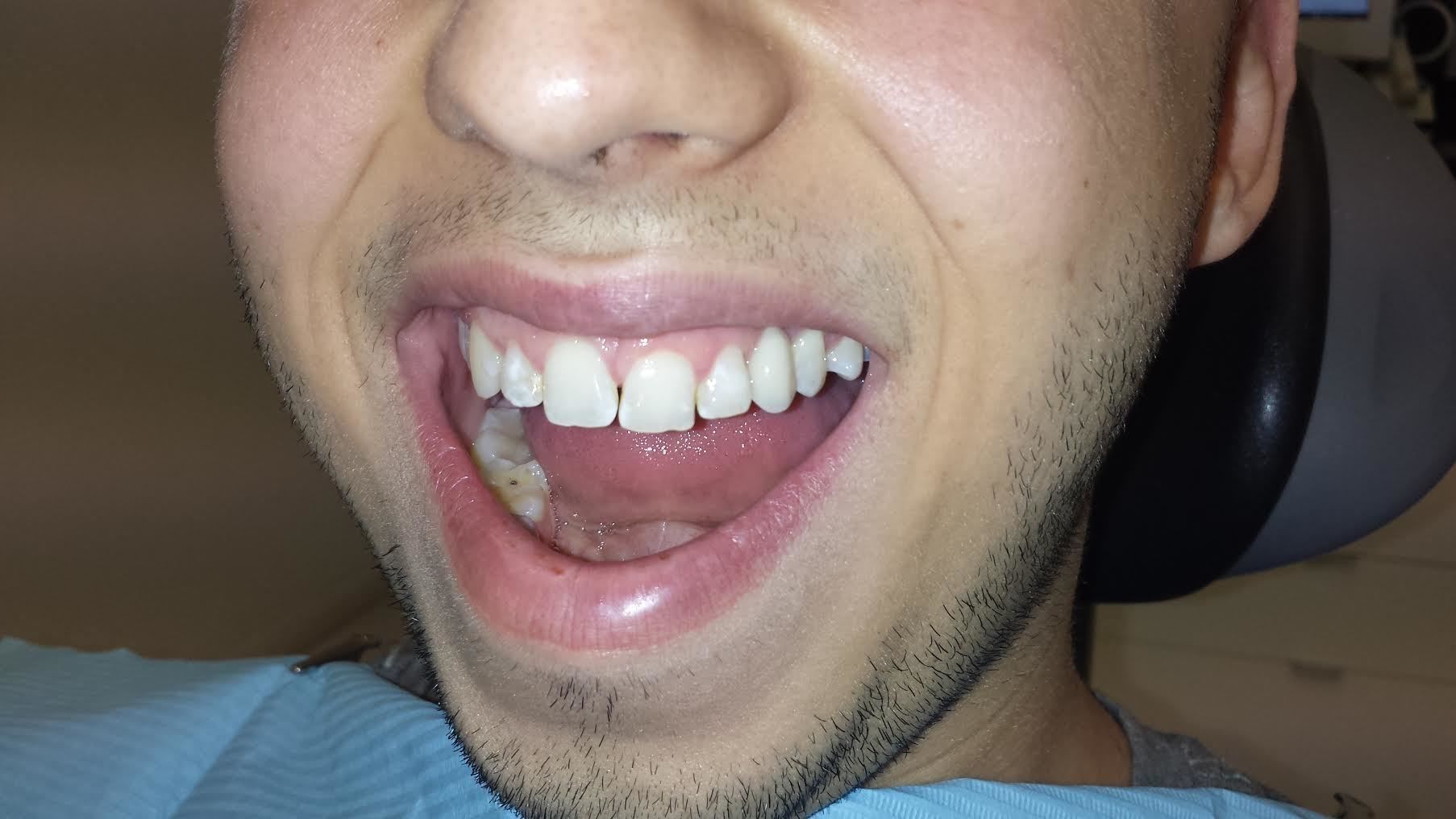 Implant dentaire : un implant dentaire merveilleux ?